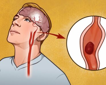 7 early warning signs of stroke everyone should know