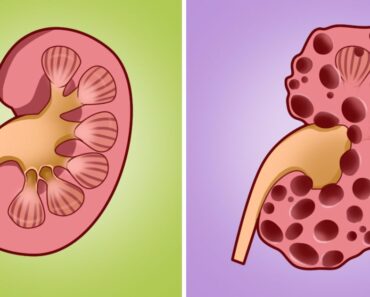 10 Habits That Can Seriously Damage Your Kidneys